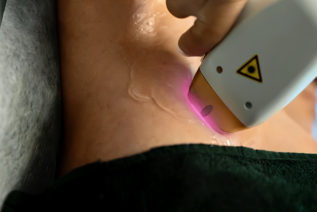 Laserontharing van de benen bij Less is More in Nijmegen